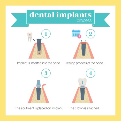 Dental-Implants-Hollywood-FL.jpg