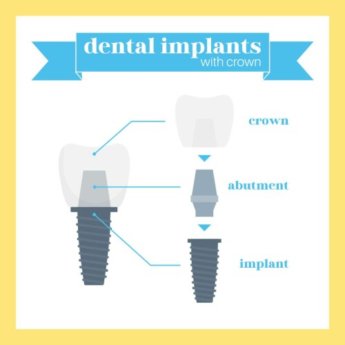 Dental-Implants-in-Hollywood-FL.jpg